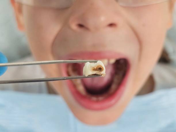 Best Urgent Tooth Repair  in Steilacoom, WA